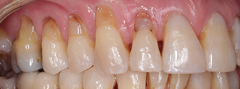 abrasion from heavy brushing wear tooth
