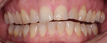 attrition teeth wear
