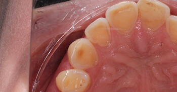 erosion wear teeth